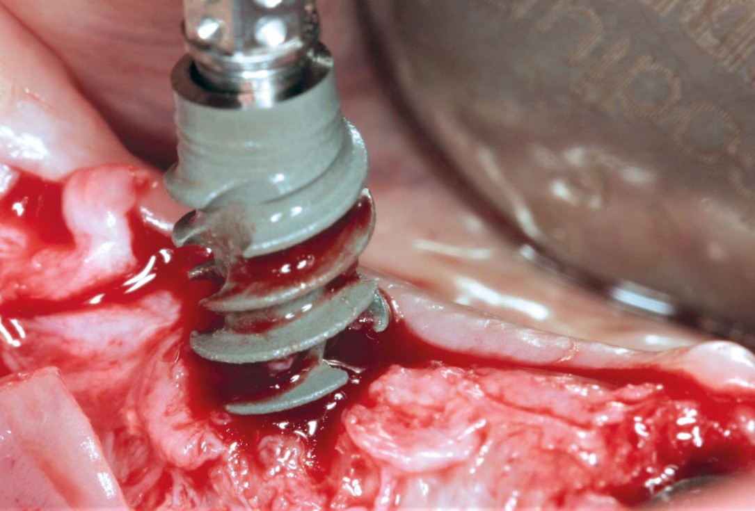 Horizontal ridge augmentation in the mandible with maxgraft® bonebuilder - Dr. O. Yüksel