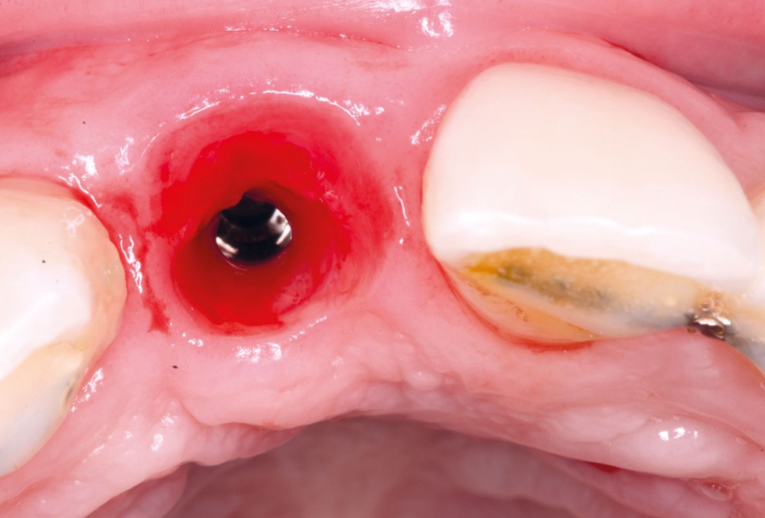 14/20 Delayed implant placement with GBR and soft tissue augmentation at the aesthetic area - 2 years follow up – Dr. H. Maghaireh & Dr. V. Ivancheva