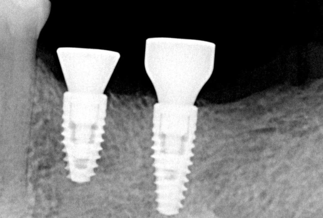 Ridge augmentation in the mandible with maxgraft® bonebuilder– Dr. R. Morger
