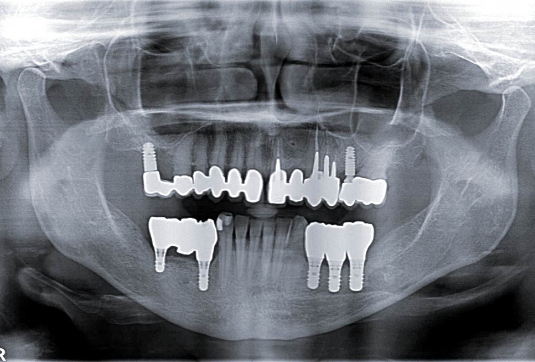 botiss maxgraft® bonebuilder for mandibular reconstruction - Clinical case