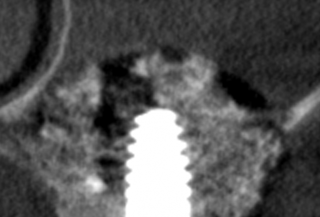 Sinus lift with simultaneous implantation with cerabone® and collprotect® membrane - clinical case Dr. Victor Kalenchuk