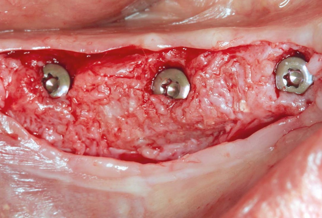 Horizontal ridge augmentation in the mandible with maxgraft® bonebuilder - Dr. O. Yüksel