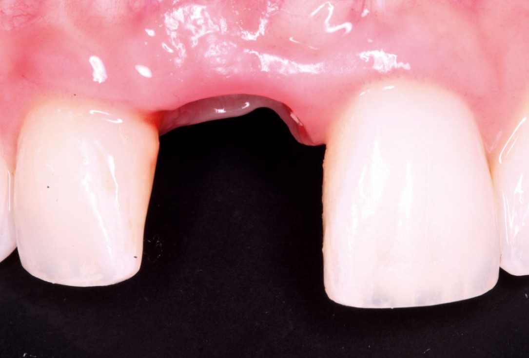 15/20 Delayed implant placement with GBR and soft tissue augmentation at the aesthetic area - 2 years follow up – Dr. H. Maghaireh & Dr. V. Ivancheva