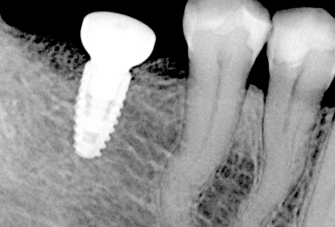 Ridge augmentation in the mandible with maxgraft® bonebuilder– Dr. R. Morger