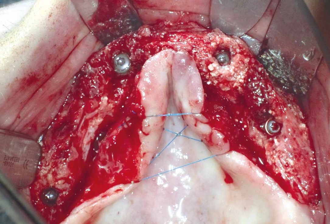 botiss maxgraft® bonebuilder for maxilla reconstruction - Clinical case