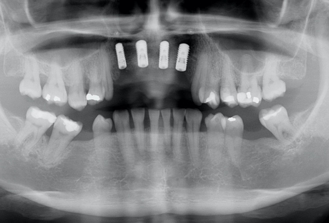 botiss maxgraft® bonebuilder aesthetic reconstruction - Clinical case