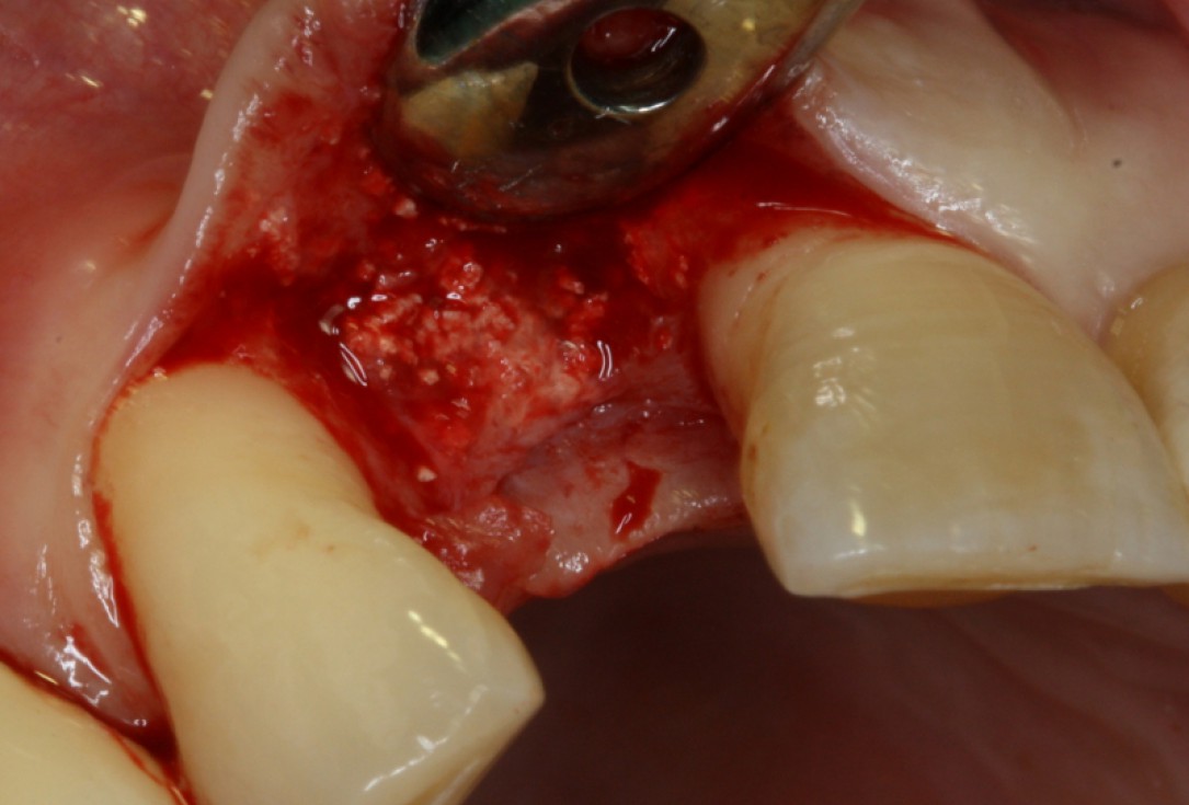 16/20 GBR with maxresorb® and Jason® membrane - Prof. Dr. Dr. D. Rothamel