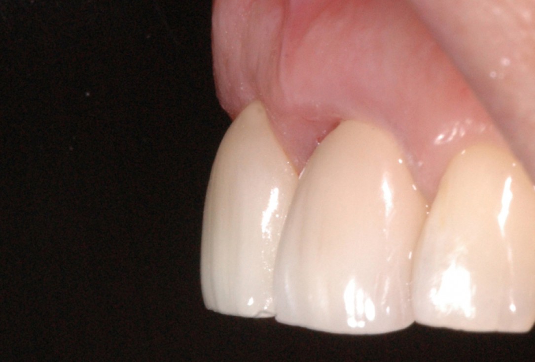 GBR together with soft tissue augmentation with mucoderm® and maxresorb® - Scherg