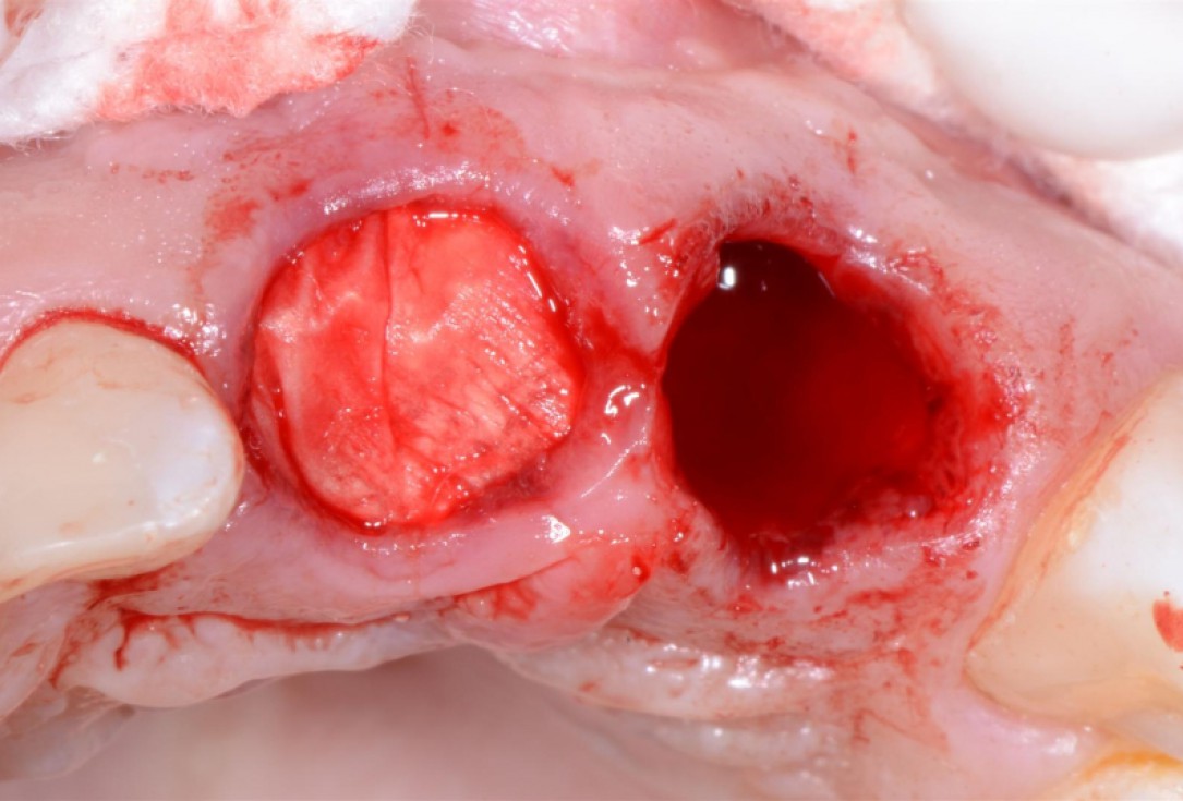 Ridge preservation with cerabone® Jason® membrane - Dr. D. Jelušić