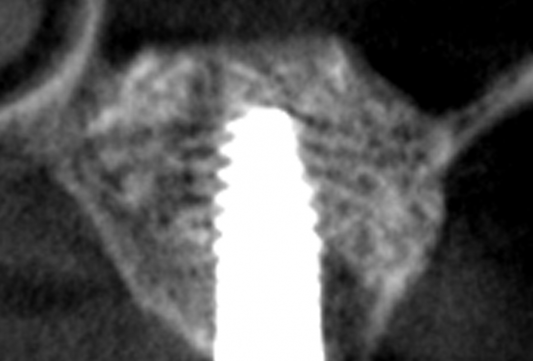 Sinus lift with simultaneous implantation with cerabone® and collprotect® membrane - clinical case Dr. Victor Kalenchuk
