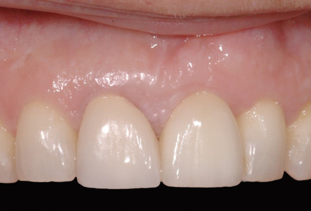 GBR together with soft tissue augmentation with mucoderm® and maxresorb® - Scherg