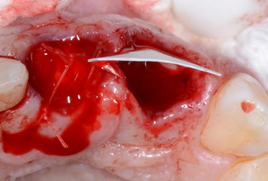 Ridge preservation with cerabone® Jason® membrane - Dr. D. Jelušić