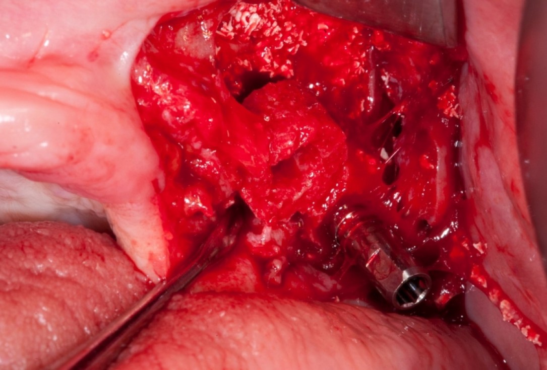 Vertical augmentation and sinus lift with maxgraft® bonering - Dr. O. Yüksel and Dr. B. Giesenhagen