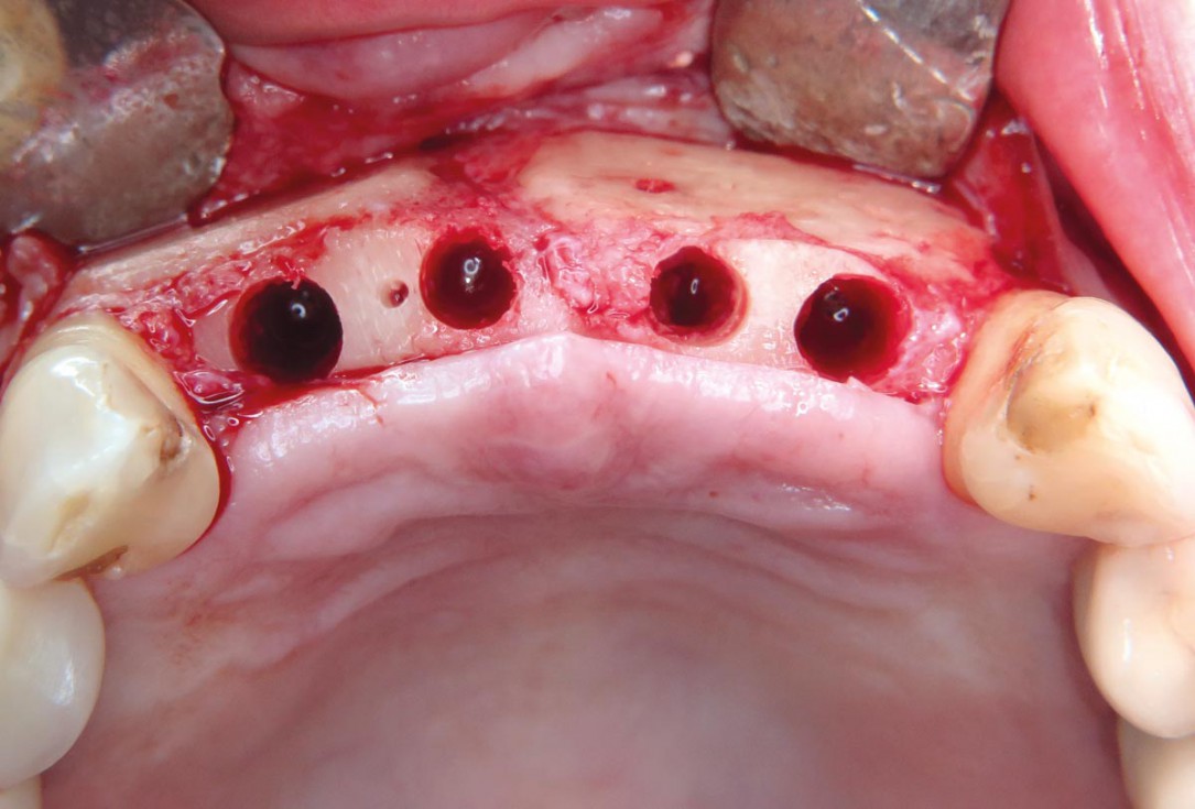 Three-dimensional augmentation with maxgraft® cortico - M.Sc. E. Kapogianni