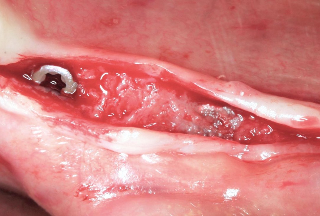 Horizontal ridge augmentation in the mandible with maxgraft® bonebuilder - Dr. O. Yüksel