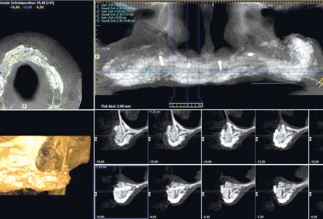 botiss maxgraft® bonebuilder for maxilla reconstruction - Clinical case
