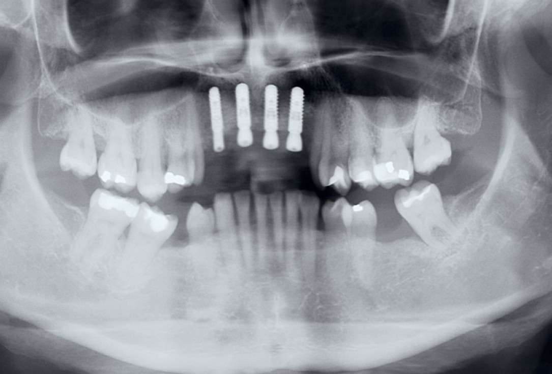 botiss maxgraft® bonebuilder aesthetic reconstruction - Clinical case