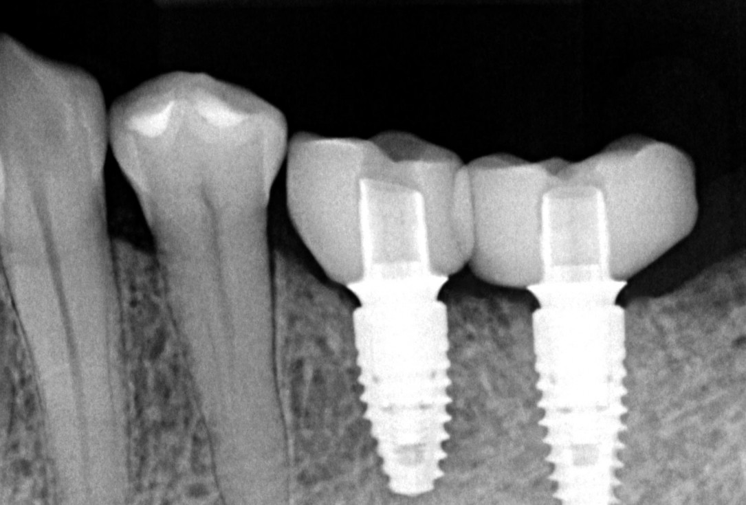 Ridge augmentation in the mandible with maxgraft® bonebuilder– Dr. R. Morger