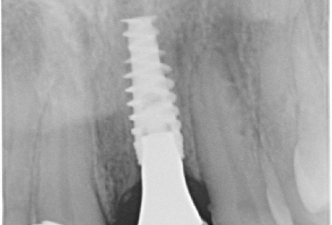 GBR together with soft tissue augmentation with mucoderm® and maxresorb® - Scherg