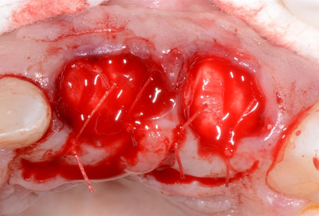 Ridge preservation with cerabone® Jason® membrane - Dr. D. Jelušić