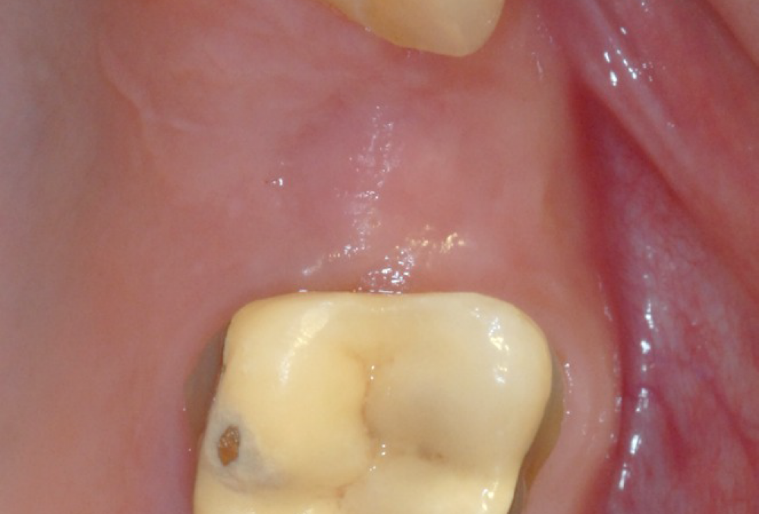 Ridge preservation with cerabone® and Jason® membrane - Dr. Derk Siebers