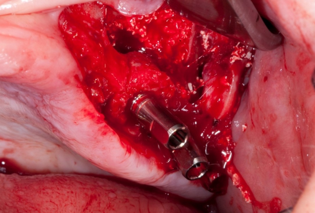 Vertical augmentation and sinus lift with maxgraft® bonering - Dr. O. Yüksel and Dr. B. Giesenhagen