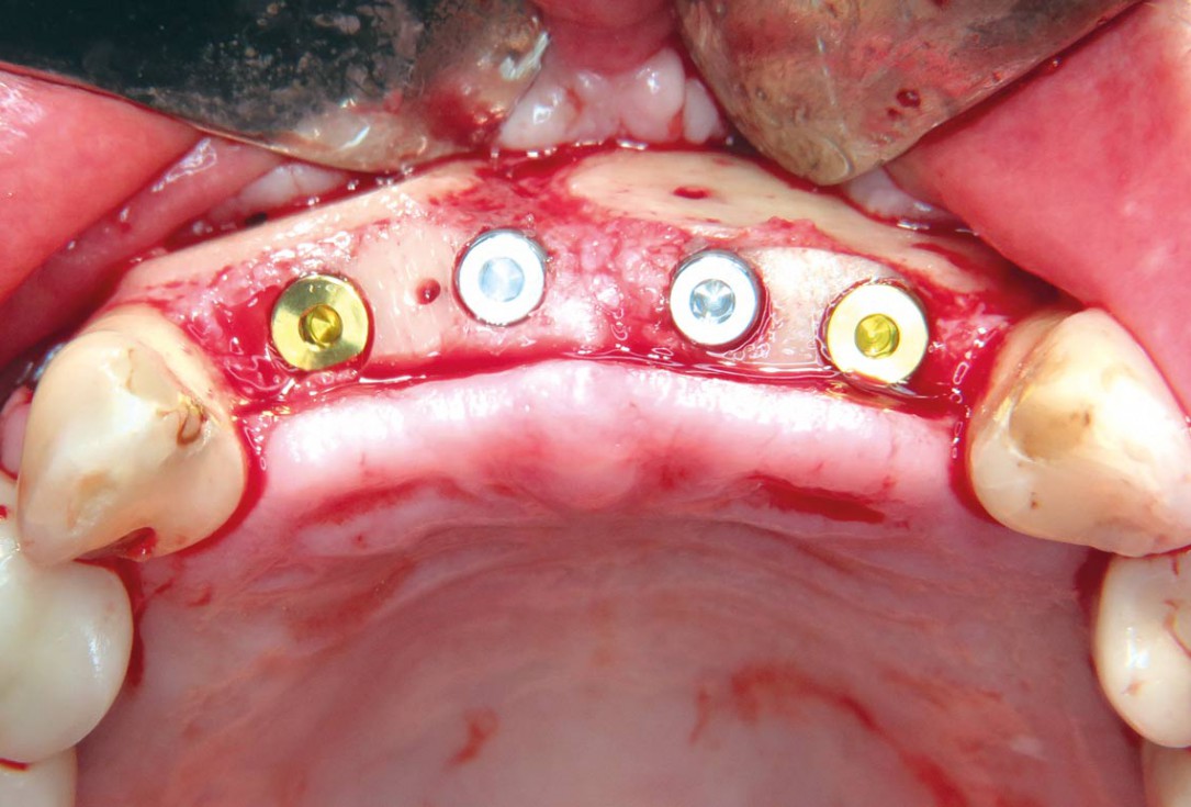 Three-dimensional augmentation with maxgraft® cortico - M.Sc. E. Kapogianni