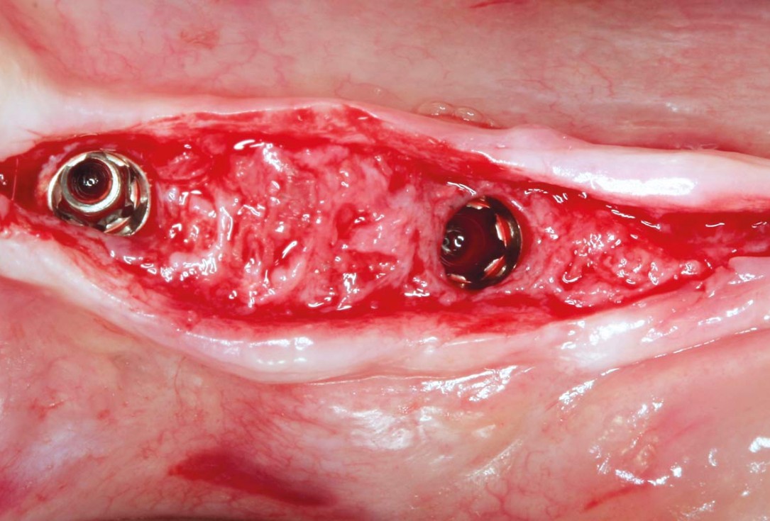 Horizontal ridge augmentation in the mandible with maxgraft® bonebuilder - Dr. O. Yüksel
