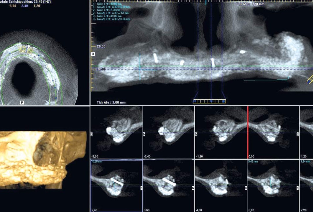 botiss maxgraft® bonebuilder for maxilla reconstruction - Clinical case