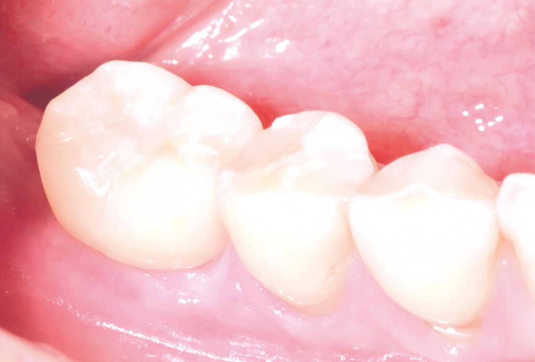 Ridge augmentation in the mandible with maxgraft® bonebuilder– Dr. R. Morger