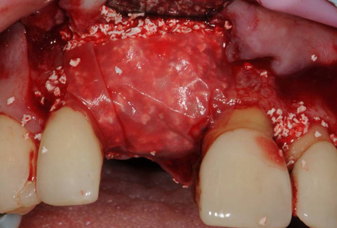 Restoration of buccal bone lamella in aesthetic zone with maxgraft® bonering - Dr. A. Patel