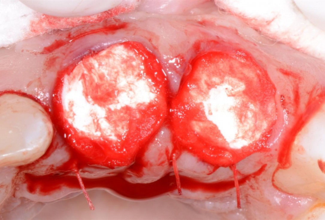 Ridge preservation with cerabone® Jason® membrane - Dr. D. Jelušić