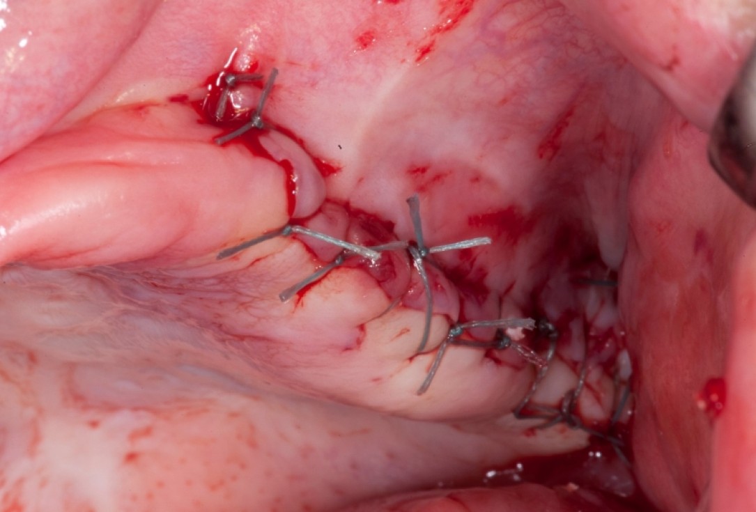 Vertical augmentation and sinus lift with maxgraft® bonering - Dr. O. Yüksel and Dr. B. Giesenhagen