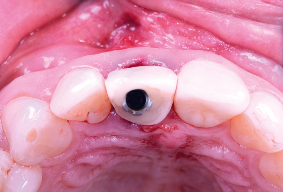 Excellent aesthetic result of buccal augmentation with mucoderm® and maxgraft® after immediate implant placement - 3-years follow-up - Dr. A. Puišys 