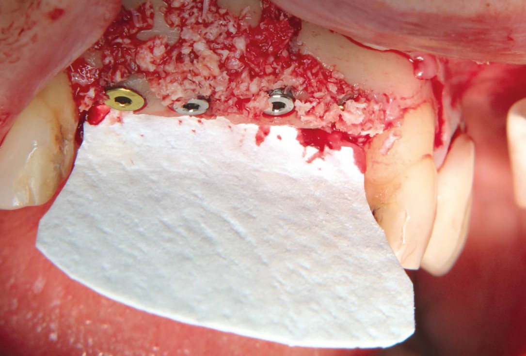 Three-dimensional augmentation with maxgraft® cortico - M.Sc. E. Kapogianni