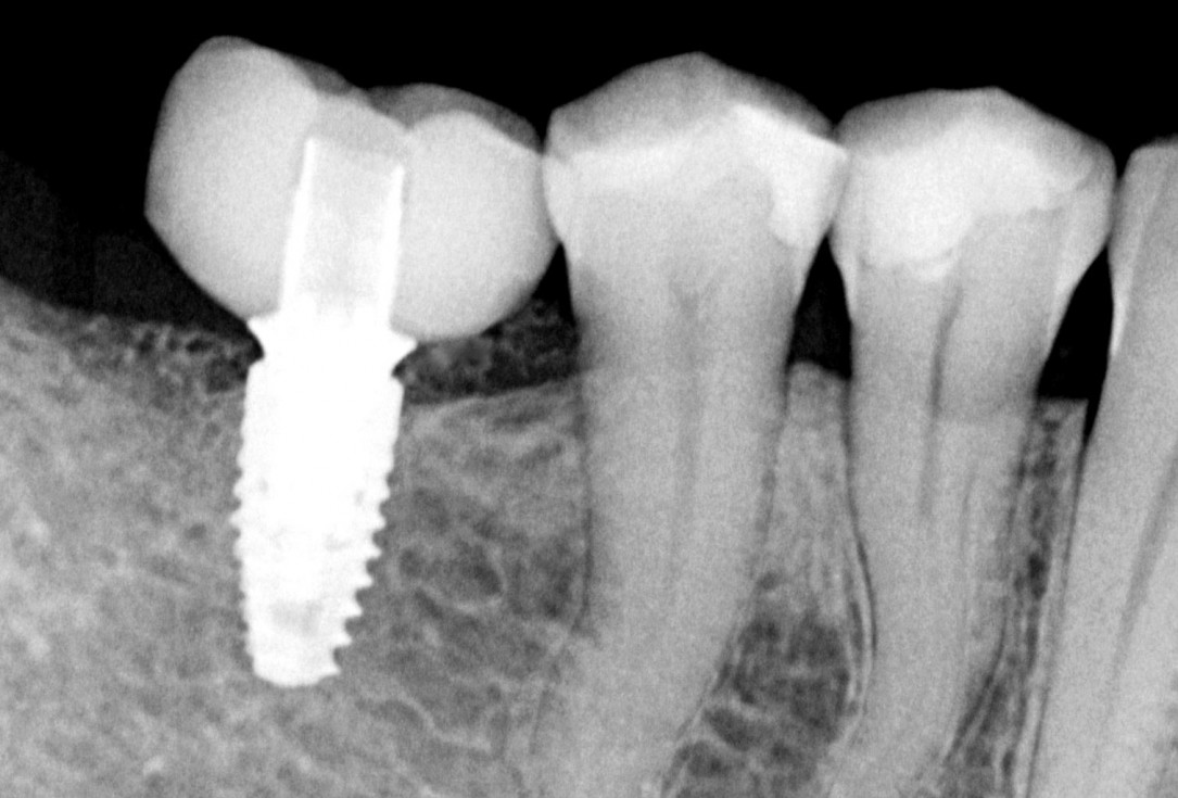 Ridge augmentation in the mandible with maxgraft® bonebuilder– Dr. R. Morger