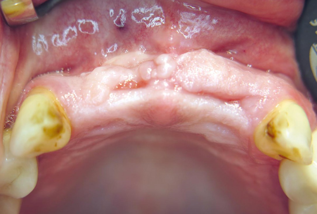 Three-dimensional augmentation with maxgraft® cortico - M.Sc. E. Kapogianni