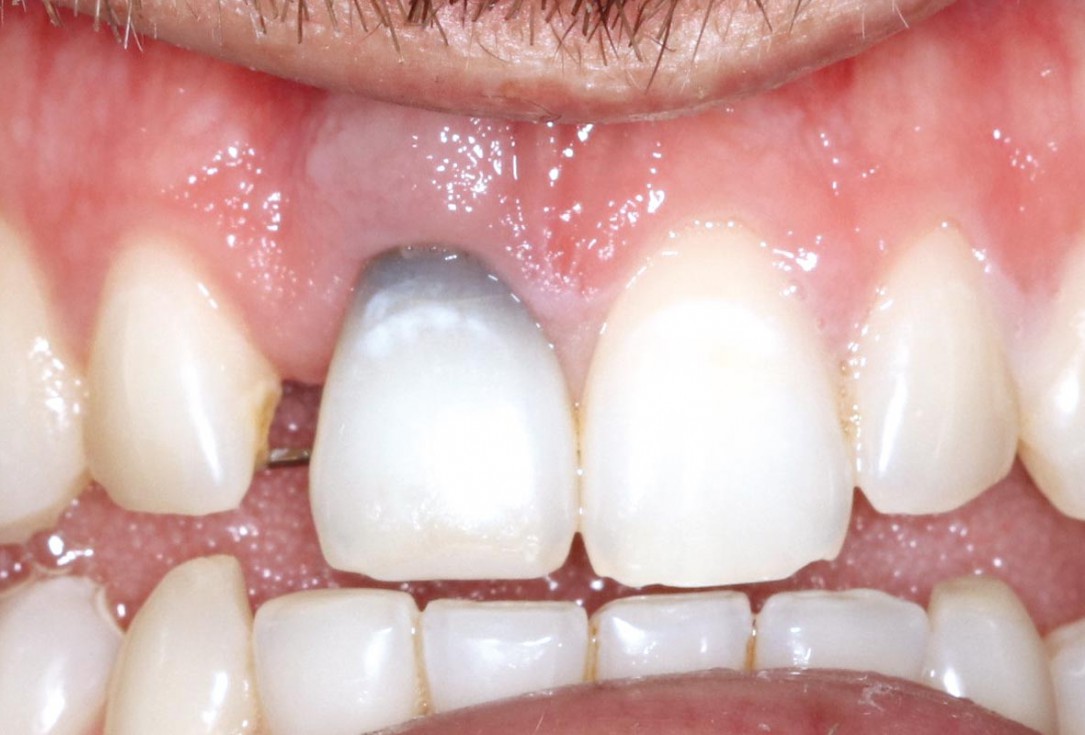 Type II socket defect grafted and repaired in a flapless way using Jason® membrane and maxgraft® cortico-cancellous - Dr. A. Jones