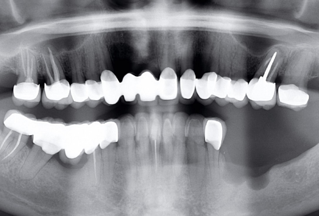 Ridge augmentation in the mandible with maxgraft® bonebuilder in a free-end situation - Dr. Dr. Dr. O. Blume