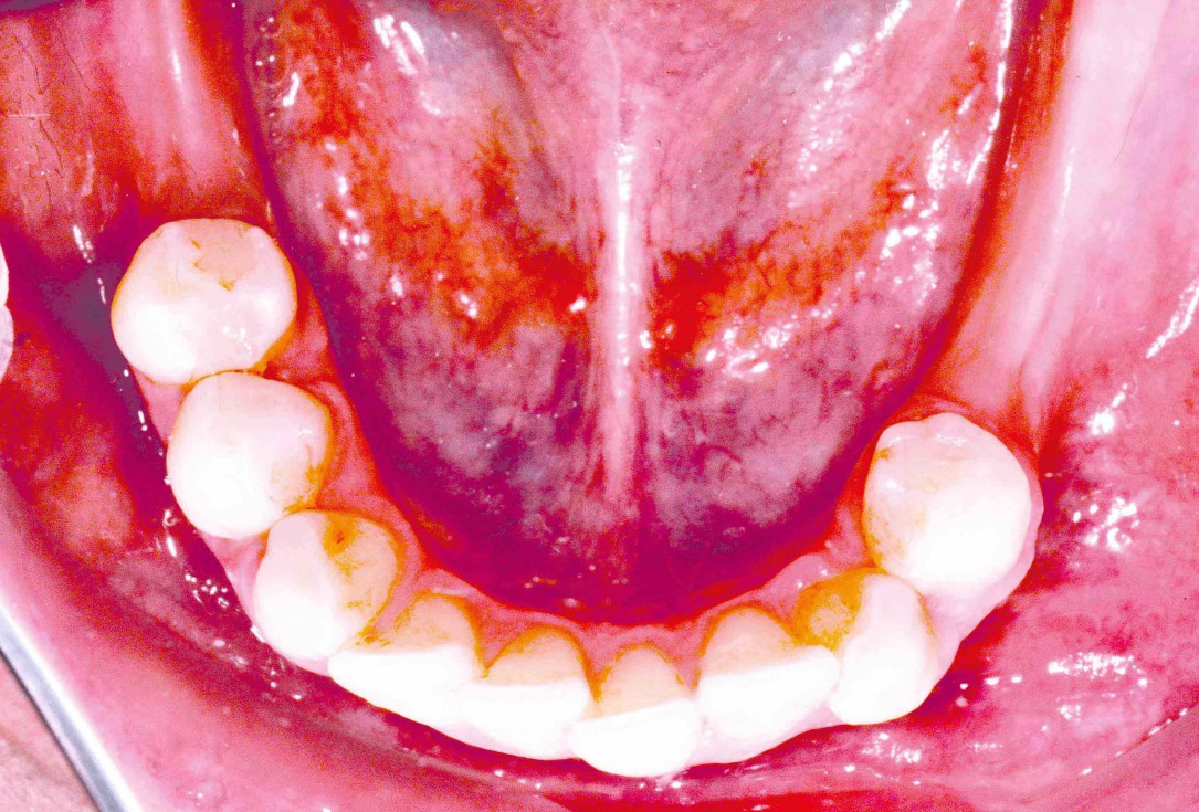 Ridge augmentation in the mandible with maxgraft® bonebuilder– Dr. R. Morger