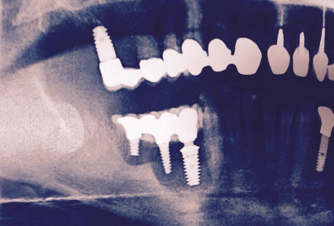 botiss maxgraft® bonebuilder for mandibular reconstruction - Clinical case
