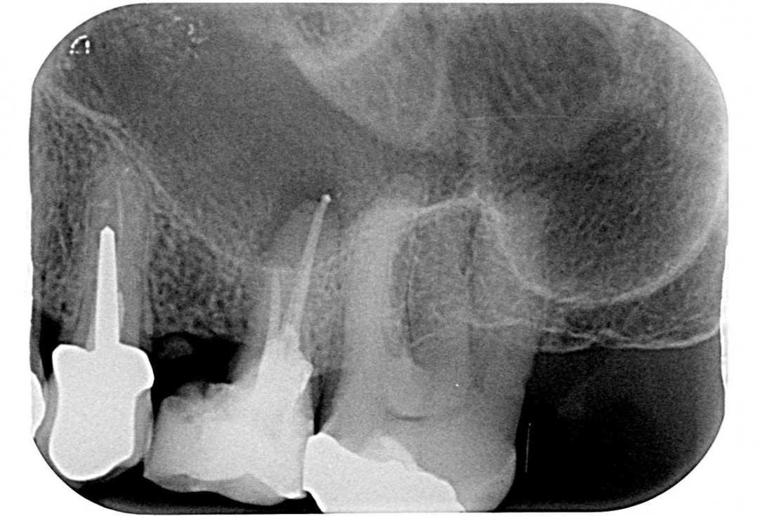 01/35 Maxillary sinus cyst removal using the Crocodile Technique and subsequent lateral sinus lift with cerabone®, maxgraft® and Jason® membrane - Dres. C. Scognamiglio and A. Perucchi