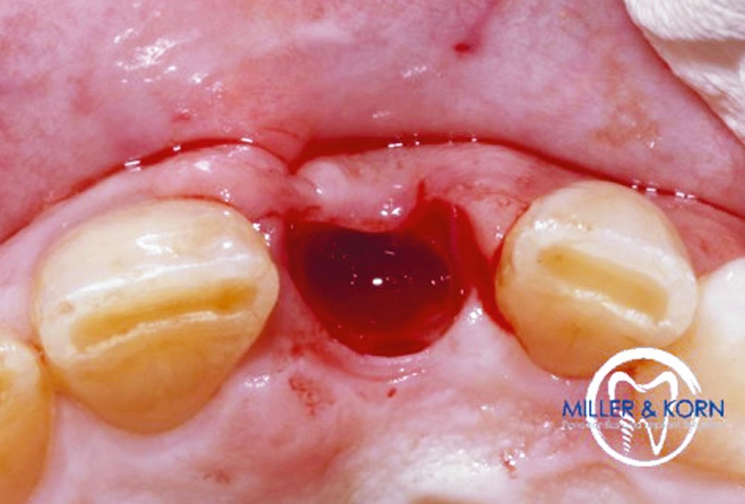 Immediate implant placement and correction of horizontal and vertical bone loss using an allograft bone ring, cerabone® and Jason® membrane - Drs. Miller and Korn