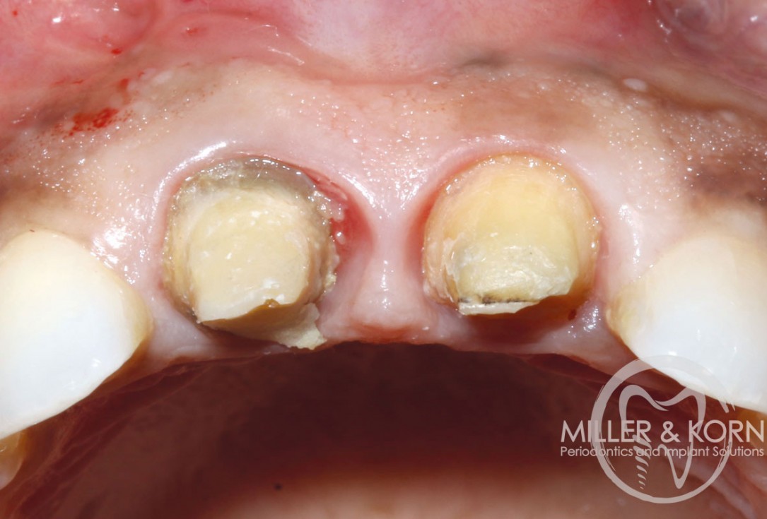 Immediate implant placement and regeneration of ridge using an allograft bone ring and Jason® membrane - Drs. Miller and Korn