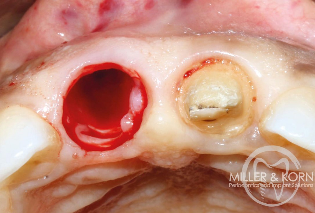 Immediate implant placement and regeneration of ridge using an allograft bone ring and Jason® membrane - Drs. Miller and Korn
