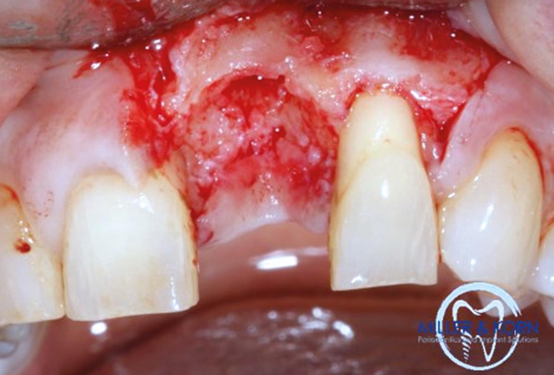 Immediate implant placement and correction of horizontal and vertical bone loss using an allograft bone ring, cerabone® and Jason® membrane - Drs. Miller and Korn