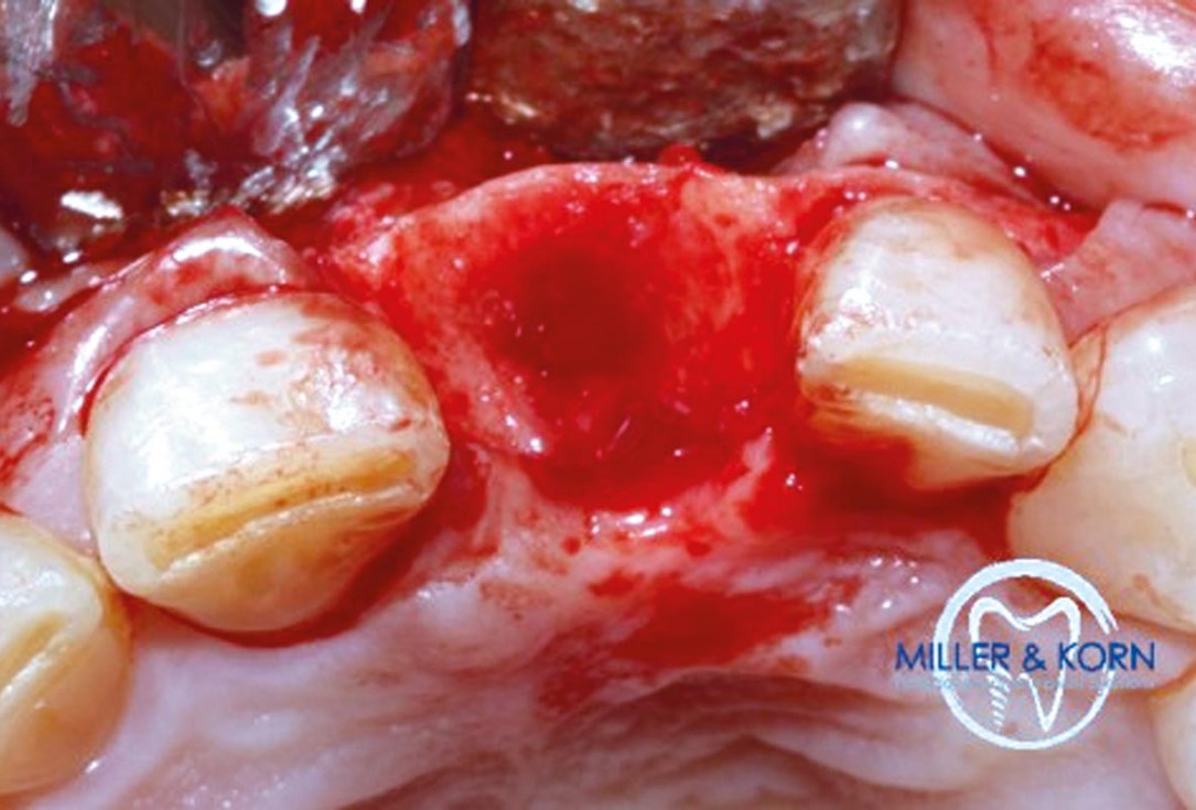 Immediate implant placement and correction of horizontal and vertical bone loss using an allograft bone ring, cerabone® and Jason® membrane - Drs. Miller and Korn