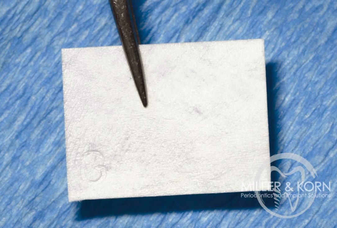 Immediate implant placement and regeneration of ridge using an allograft bone ring and Jason® membrane - Dr. Miller and Korn