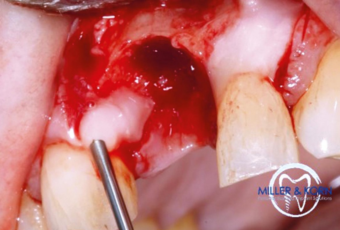 Immediate implant placement and correction of horizontal and vertical bone loss using an allograft bone ring, cerabone® and Jason® membrane - Drs. Miller and Korn