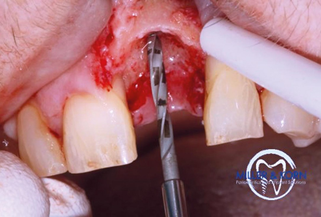 Immediate implant placement and correction of horizontal and vertical bone loss using an allograft bone ring, cerabone® and Jason® membrane - Drs. Miller and Korn